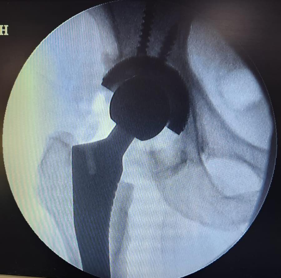 Hip Joint Replacement - Treatment result by Dr. Karthik Manchala