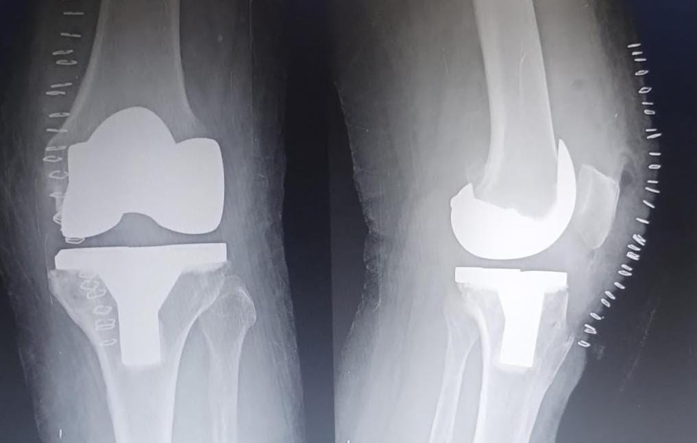 Total Knee Replacement - Treatment result by Dr. Karthik Manchala
